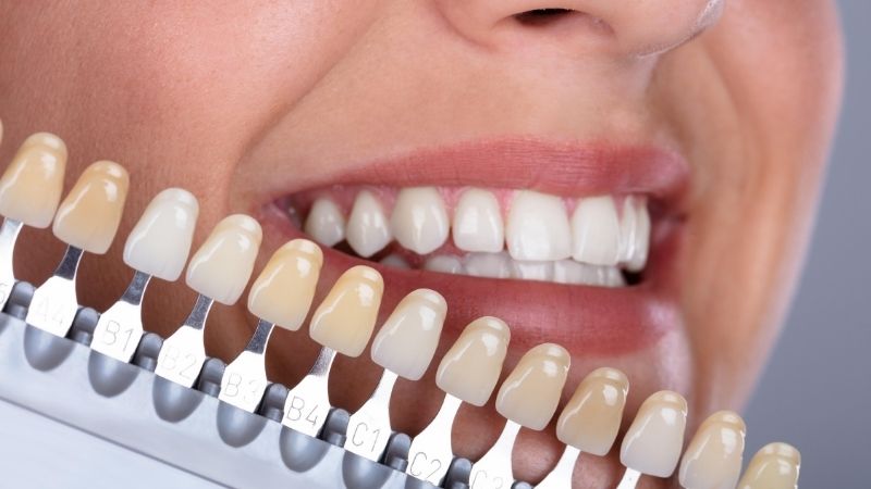 C1 tooth shade C1 tooth shade