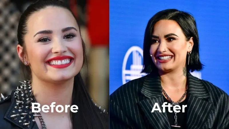 Demi Lovato veneers before after