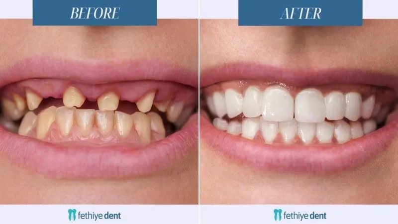 E-max veneers vs. Laminate veneers