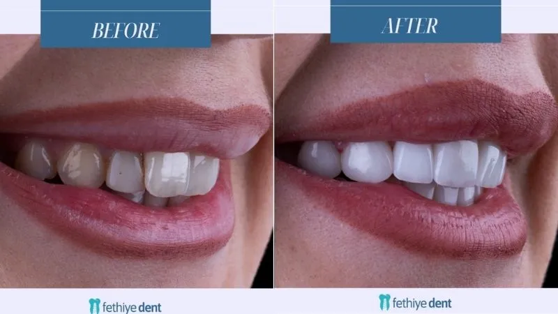 Is It Safe to Have Dental Implants in Turkey?