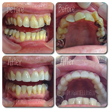 Fethiye Dental Treatments Before After Photos Fethiye Dental Treatments Before After Photos