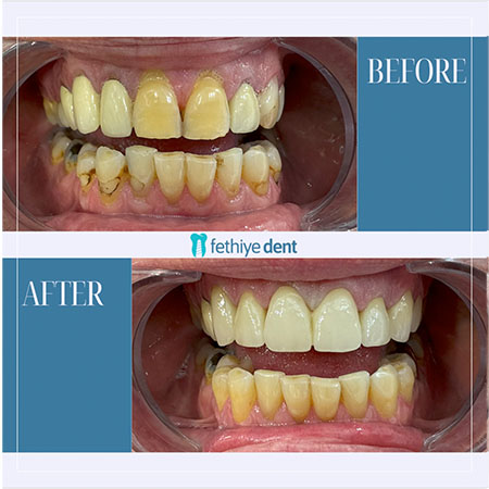Fethiye Dental Treatments Before After Photos Fethiye Dental Treatments Before After Photos9