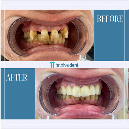 Fethiye Dental Treatments Before After Photos Fethiye Dental Treatments Before After Photos10