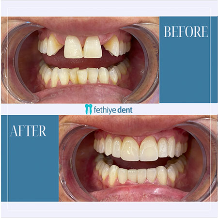 Fethiye Dental Treatments Before After Photos Fethiye Dental Treatments Before After Photos11