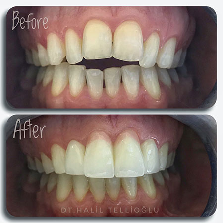 Fethiye Dental Treatments Before After Photos Fethiye Dental Treatments Before After Photos1