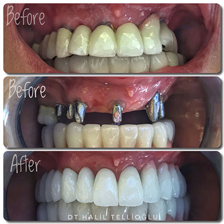 Fethiye Dental Treatments Before After Photos Fethiye Dental Treatments Before After Photos2