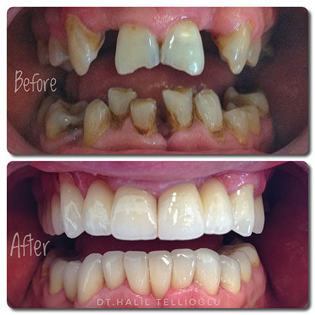 Fethiye Dental Treatments Before After Photos Fethiye Dental Treatments Before After Photos3
