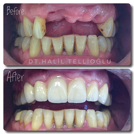 Fethiye Dental Treatments Before After Photos Fethiye Dental Treatments Before After Photos4