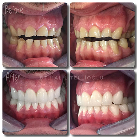 Fethiye Dental Treatments Before After Photos Fethiye Dental Treatments Before After Photos5