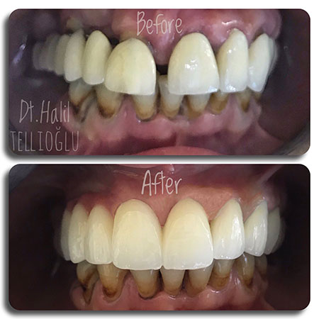 Fethiye Dental Treatments Before After Photos Fethiye Dental Treatments Before After Photos6