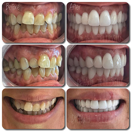 Fethiye Dental Treatments Before After Photos Fethiye Dental Treatments Before After Photos7