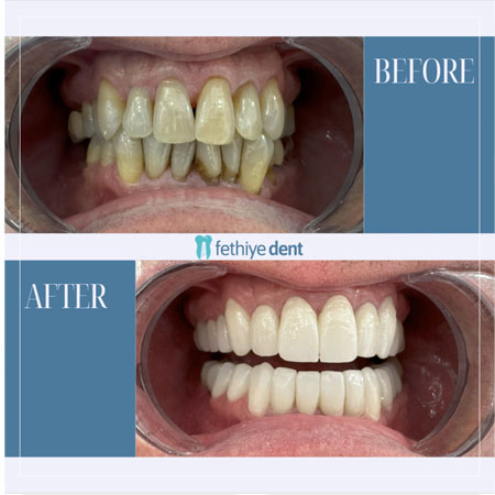 Fethiye Dental Treatments Before After Photos Fethiye Dental Treatments Before After Photos8