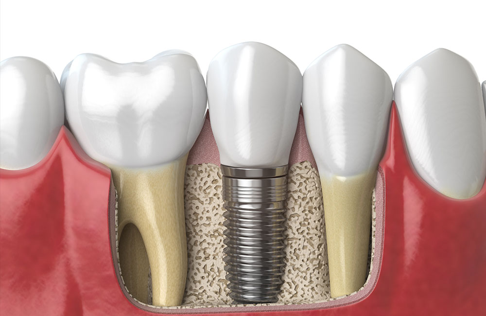 Dental Implant in Fethiye Dental Implant in Turkey