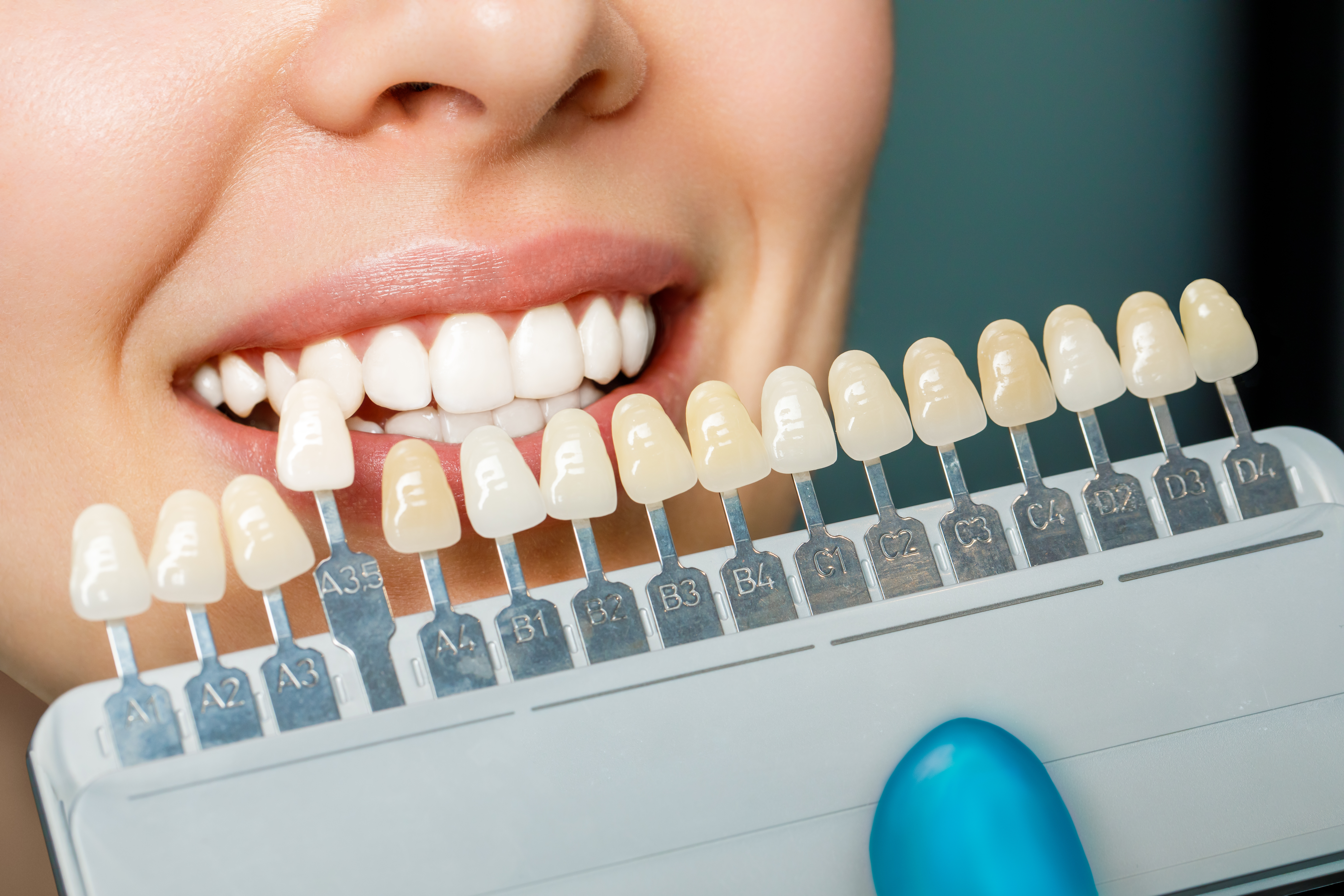 Emax Laminate Veneers Turkey