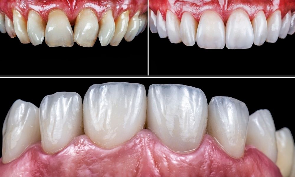Emax Veneers Fethiye