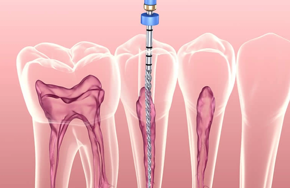 Root canal treatment Turkey